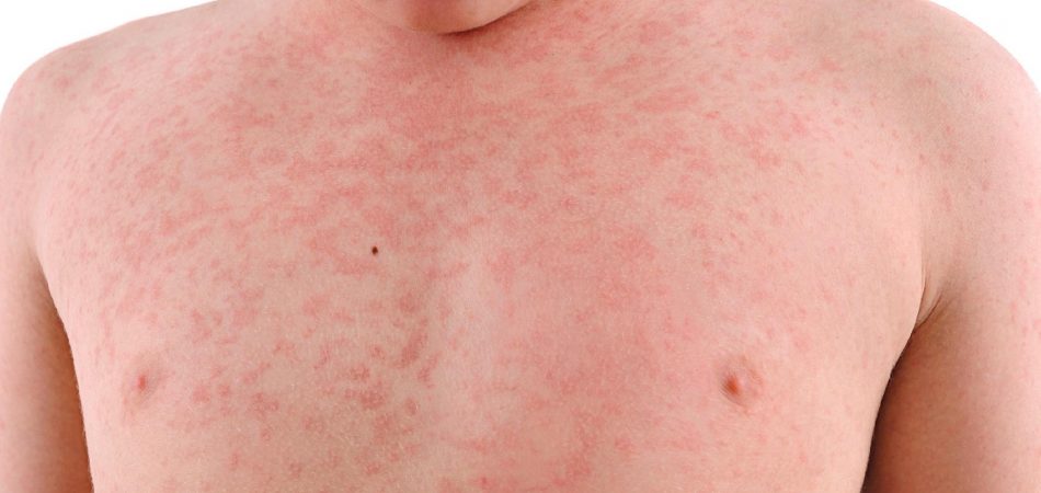 Orientações sobre a noficação da Síndrome Inflamatória Mulssistêmica Pediátrica (SIM-P), temporalmente associada à COVID-19.